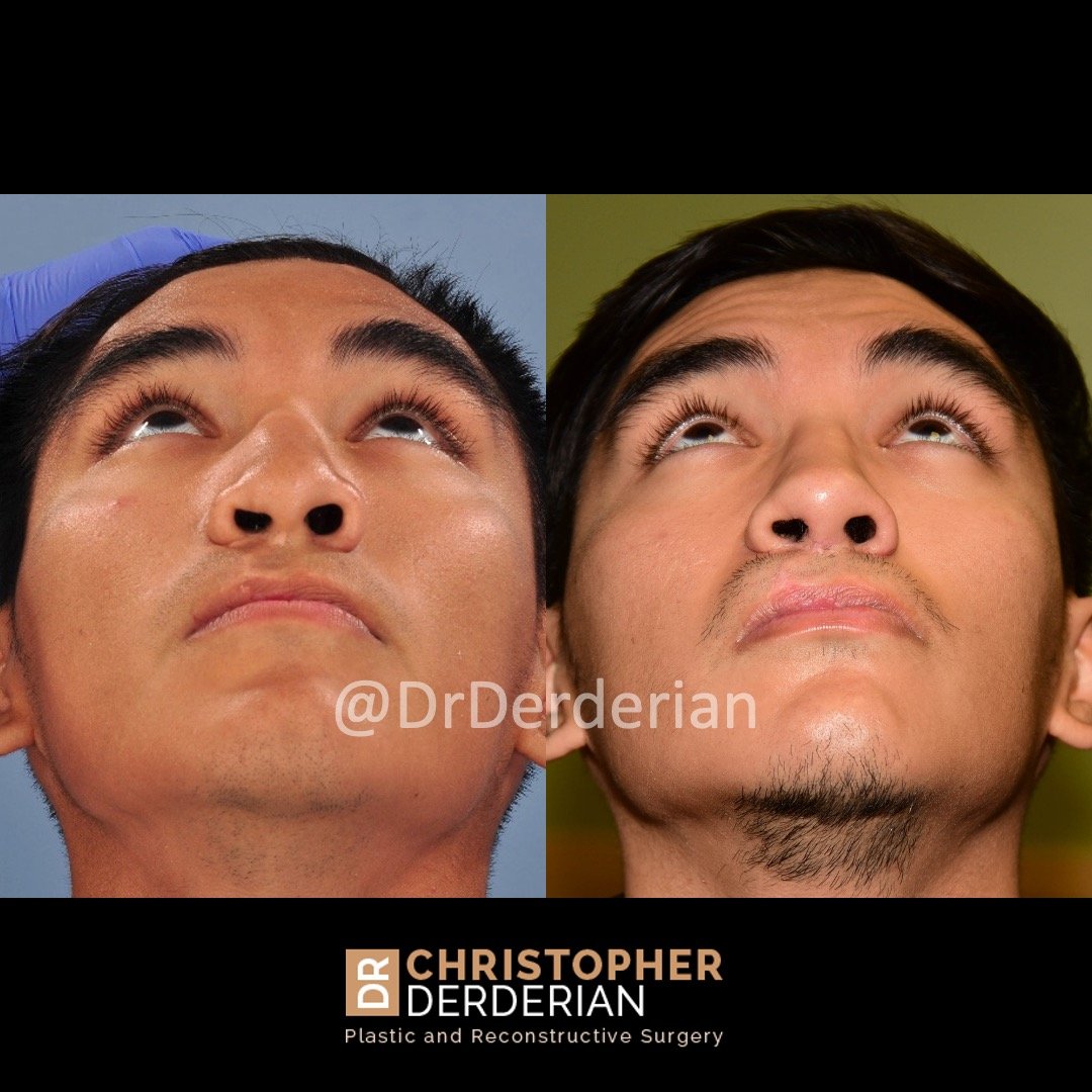 before and after cleft rhinoplasty case 5 Below view