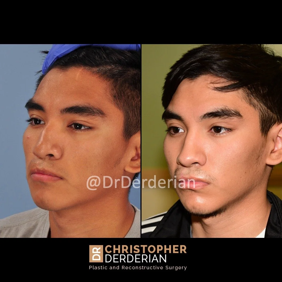 Cleft Rhinoplasty — Dr Derderian — Plastic and Reconstructive Surgery