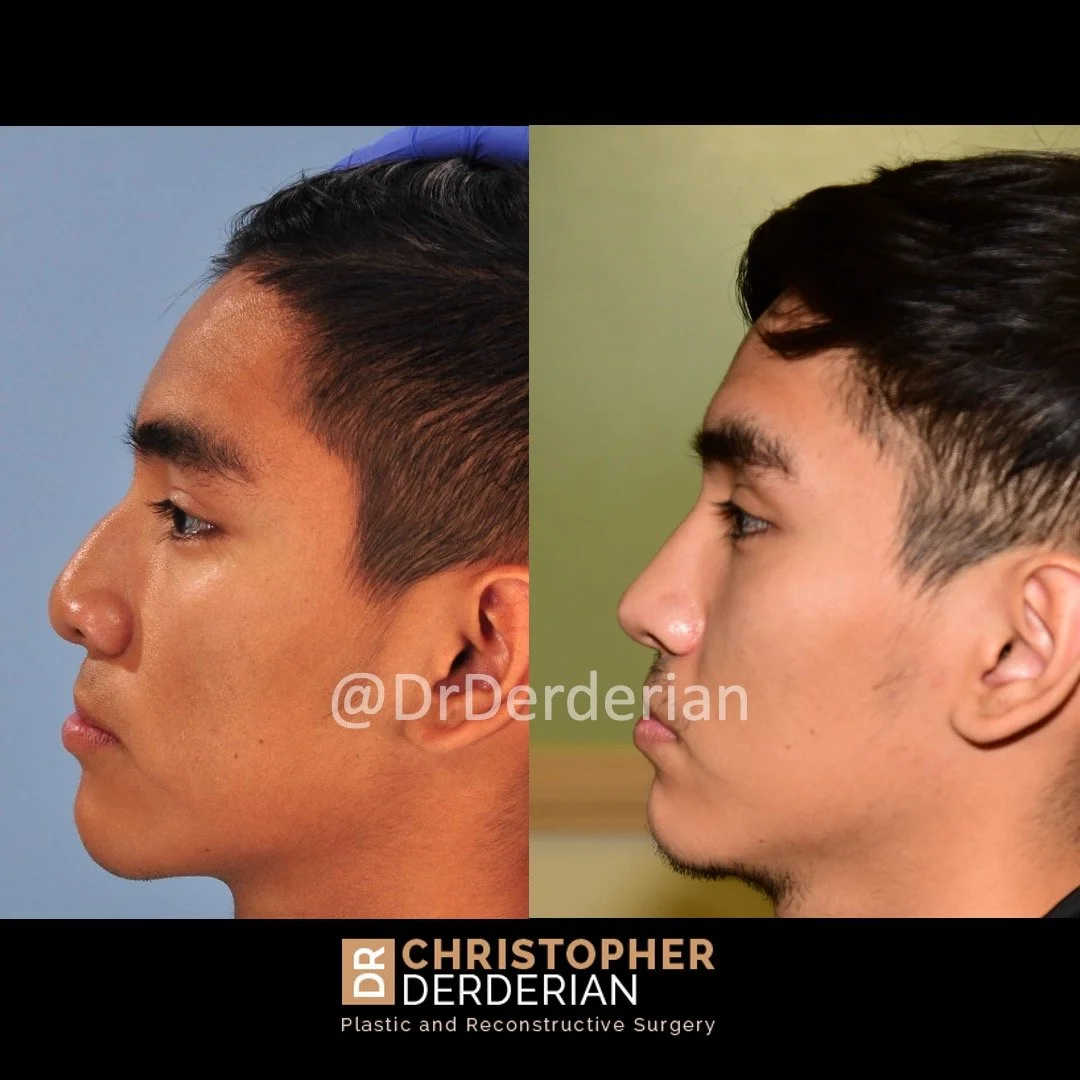 before and after cleft rhinoplasty case 5 left lateral