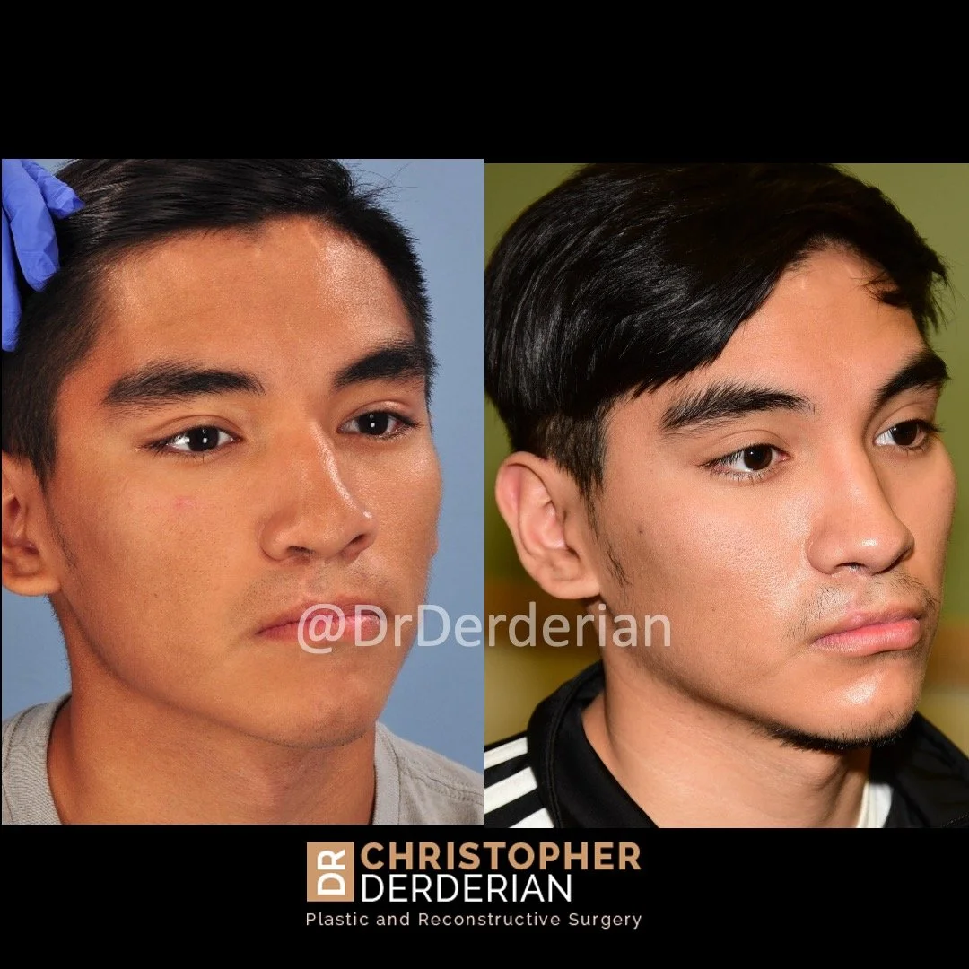 before and after cleft rhinoplasty case 5 right 3/4