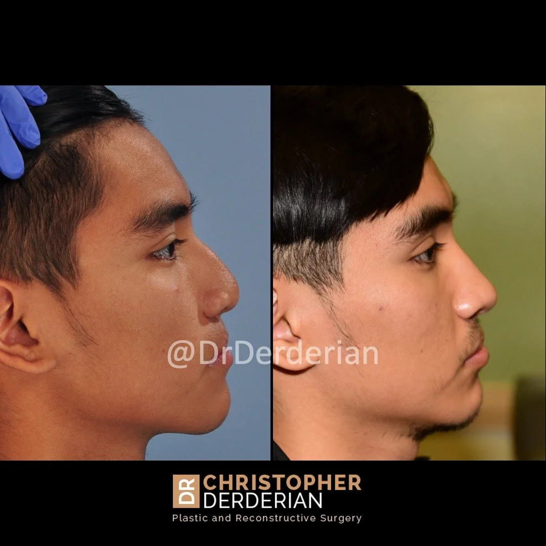 before and after cleft rhinoplasty case 5 right lateral