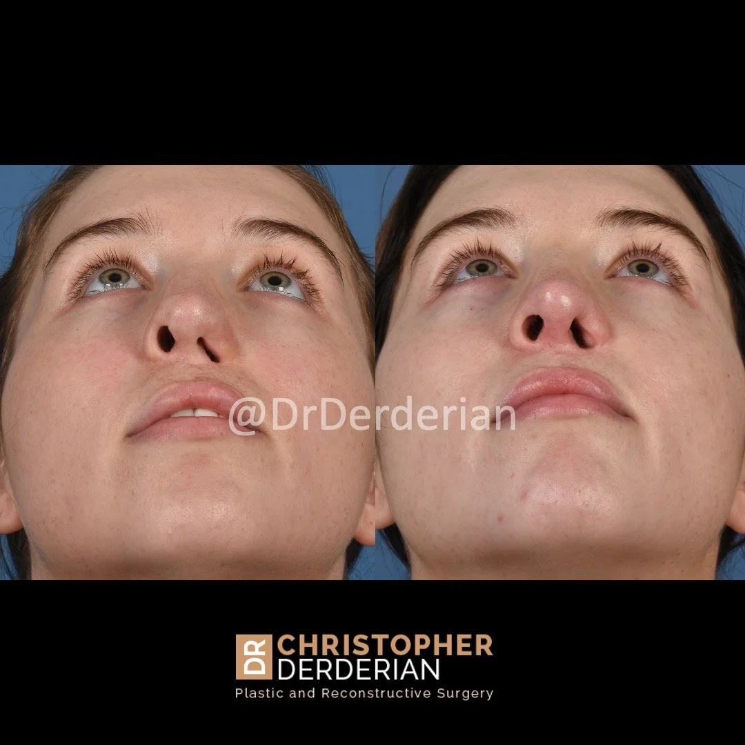 before and after cleft rhinoplasty case 6 below 3/4
