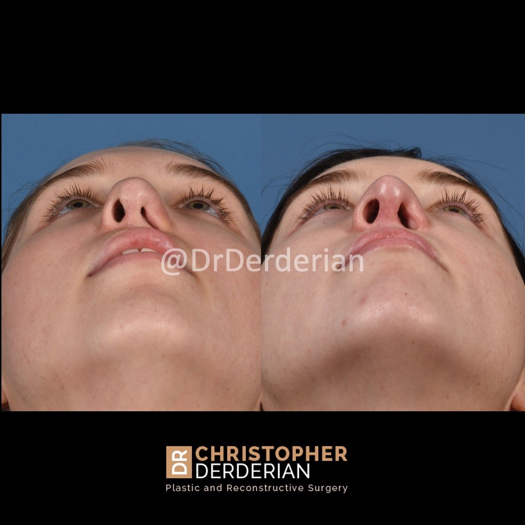 before and after cleft rhinoplasty case 6 below view