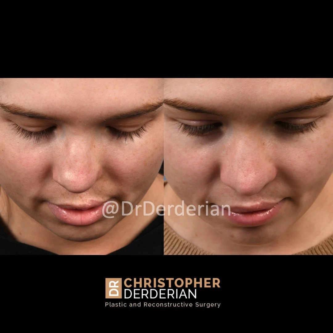 before and after cleft rhinoplasty case 6 above