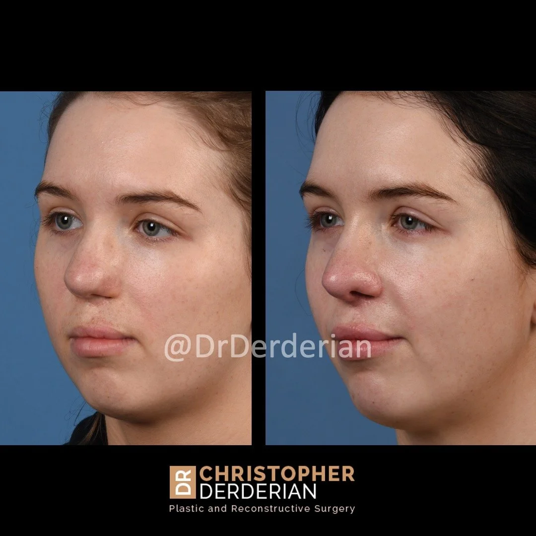 before and after cleft rhinoplasty case 6 Left 1/2