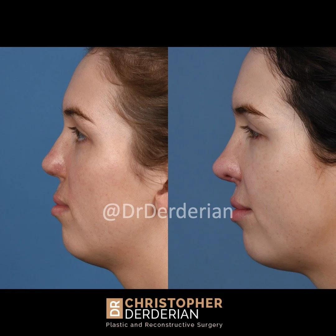 before and after cleft rhinoplasty case 6 Left lateral