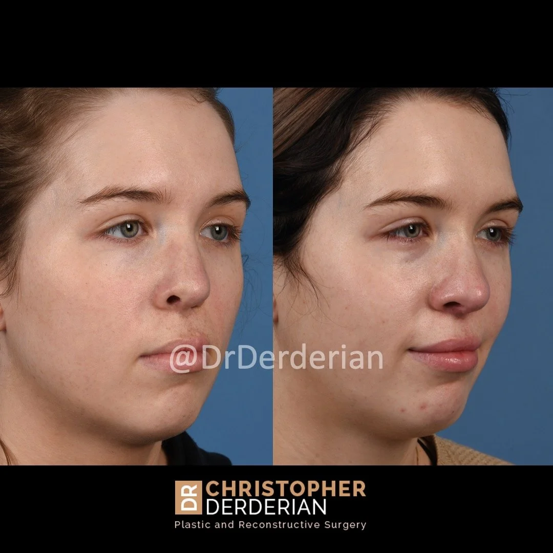 before and after cleft rhinoplasty case 6 right 1/2