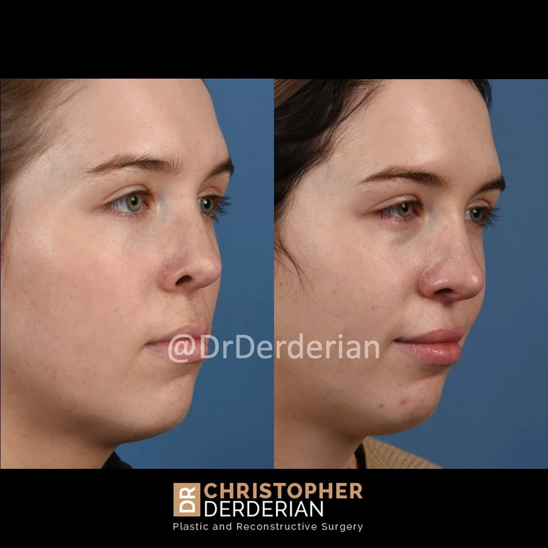 before and after cleft rhinoplasty case 6 right 3/4
