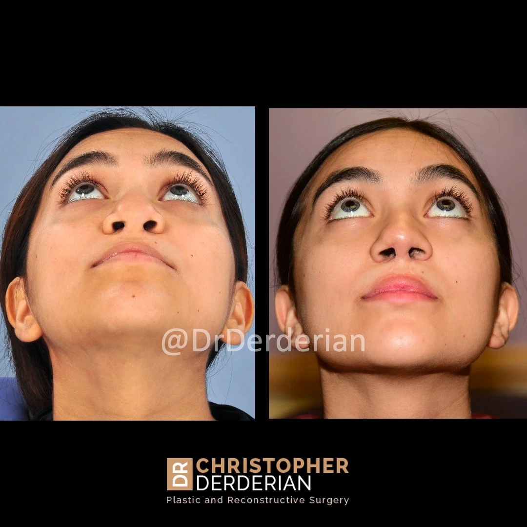 before and after cleft rhinoplasty case 7 below view