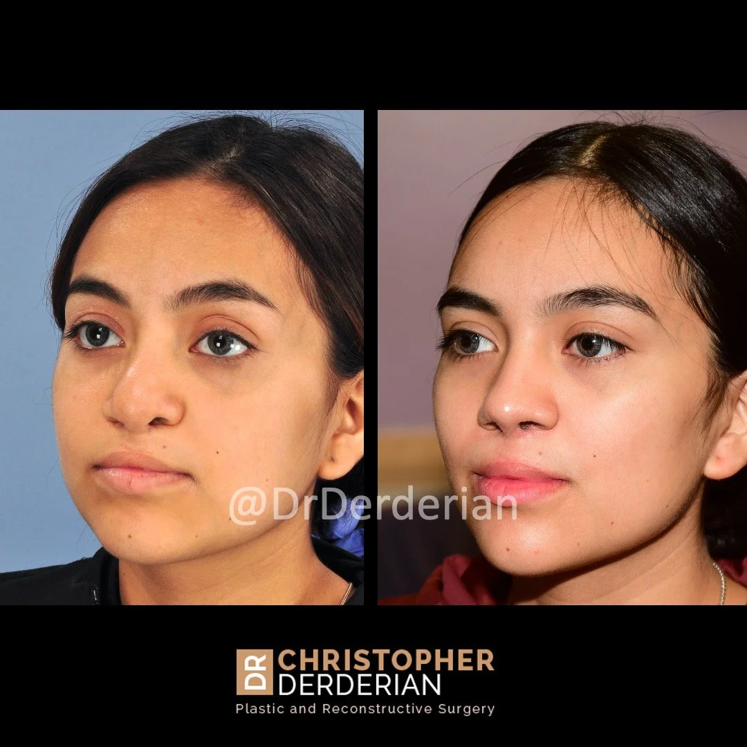 before and after cleft rhinoplasty case 7 left 3/4