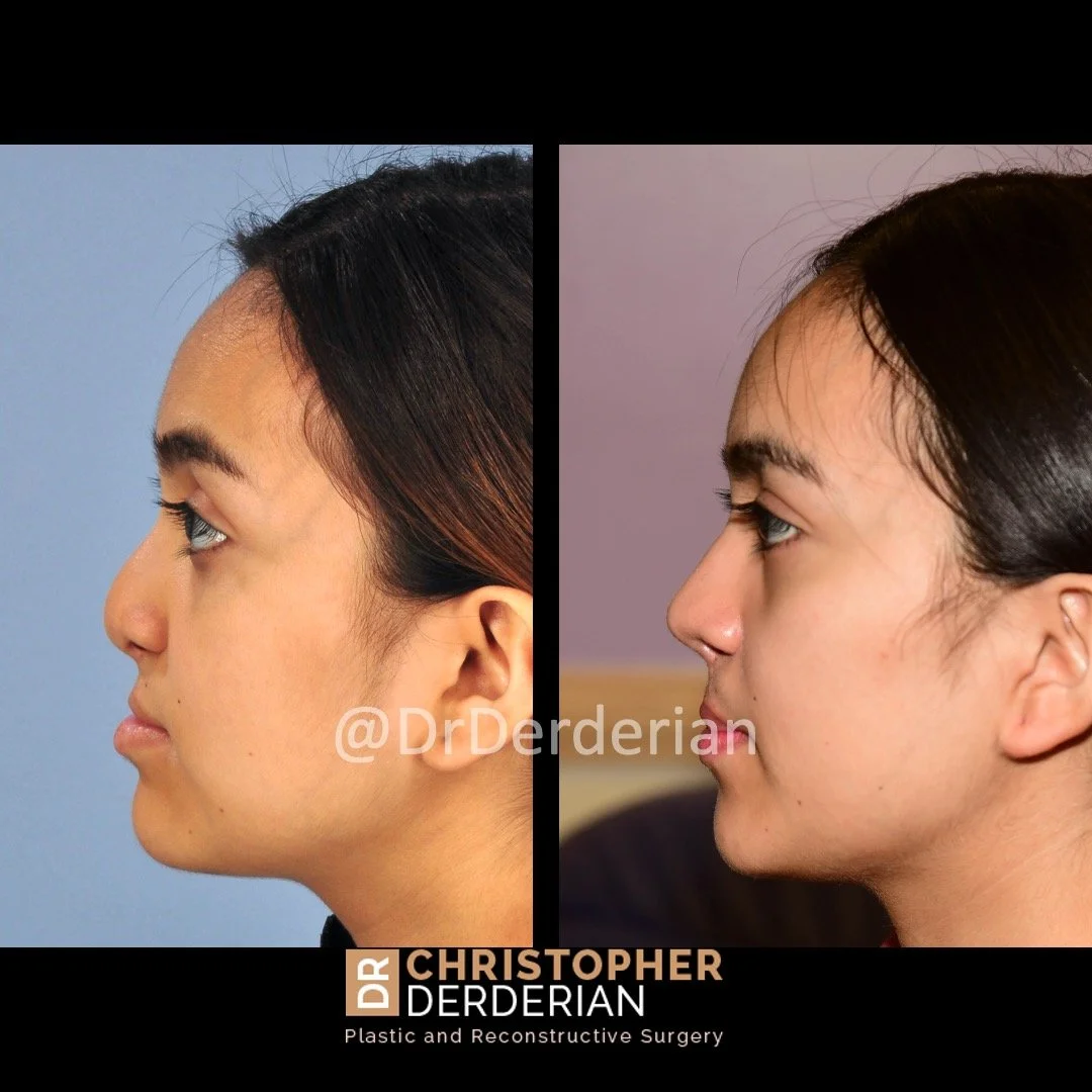before and after cleft rhinoplasty case 7 left lateral