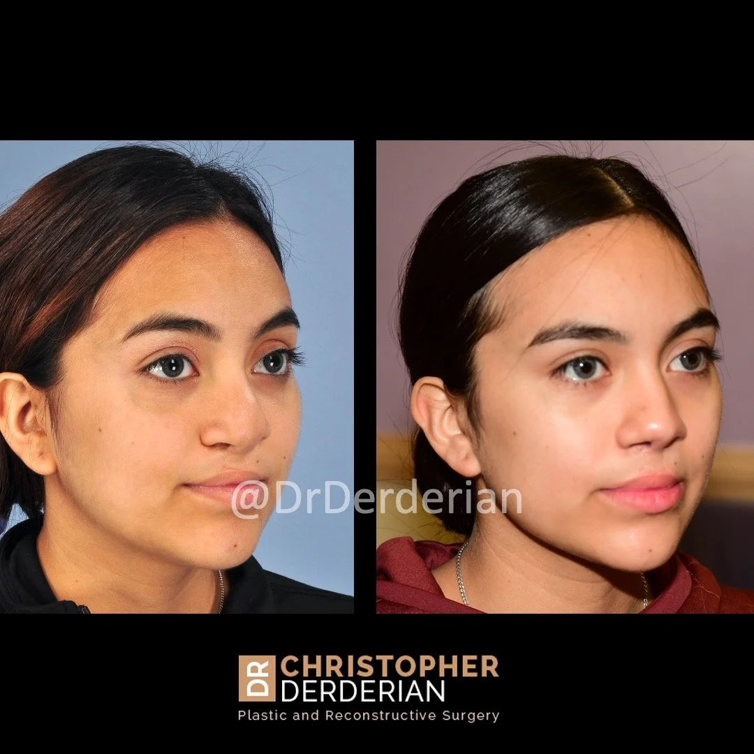 before and after cleft rhinoplasty case 7 right 3/4