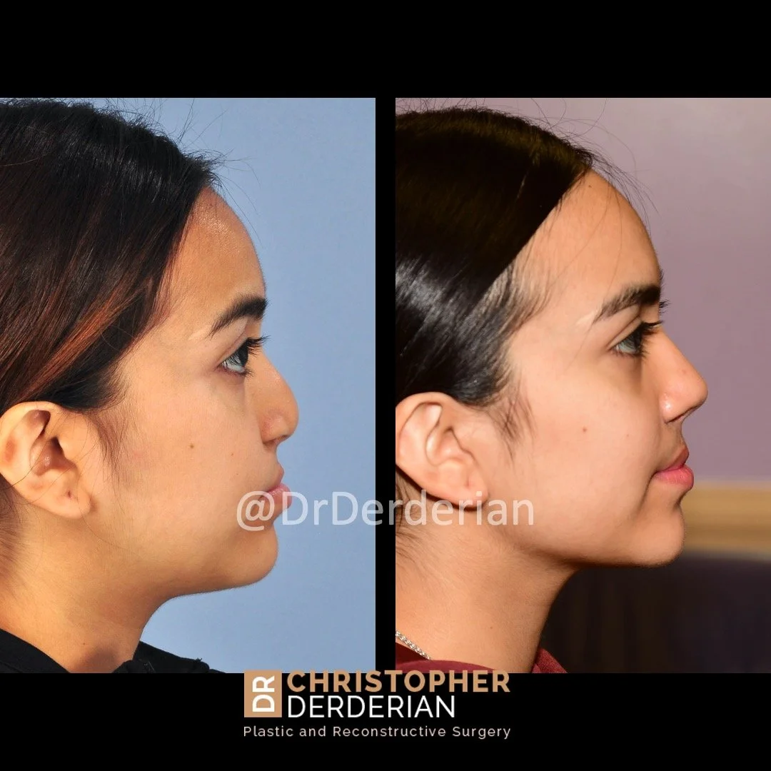 before and after cleft rhinoplasty case 7 right lateral