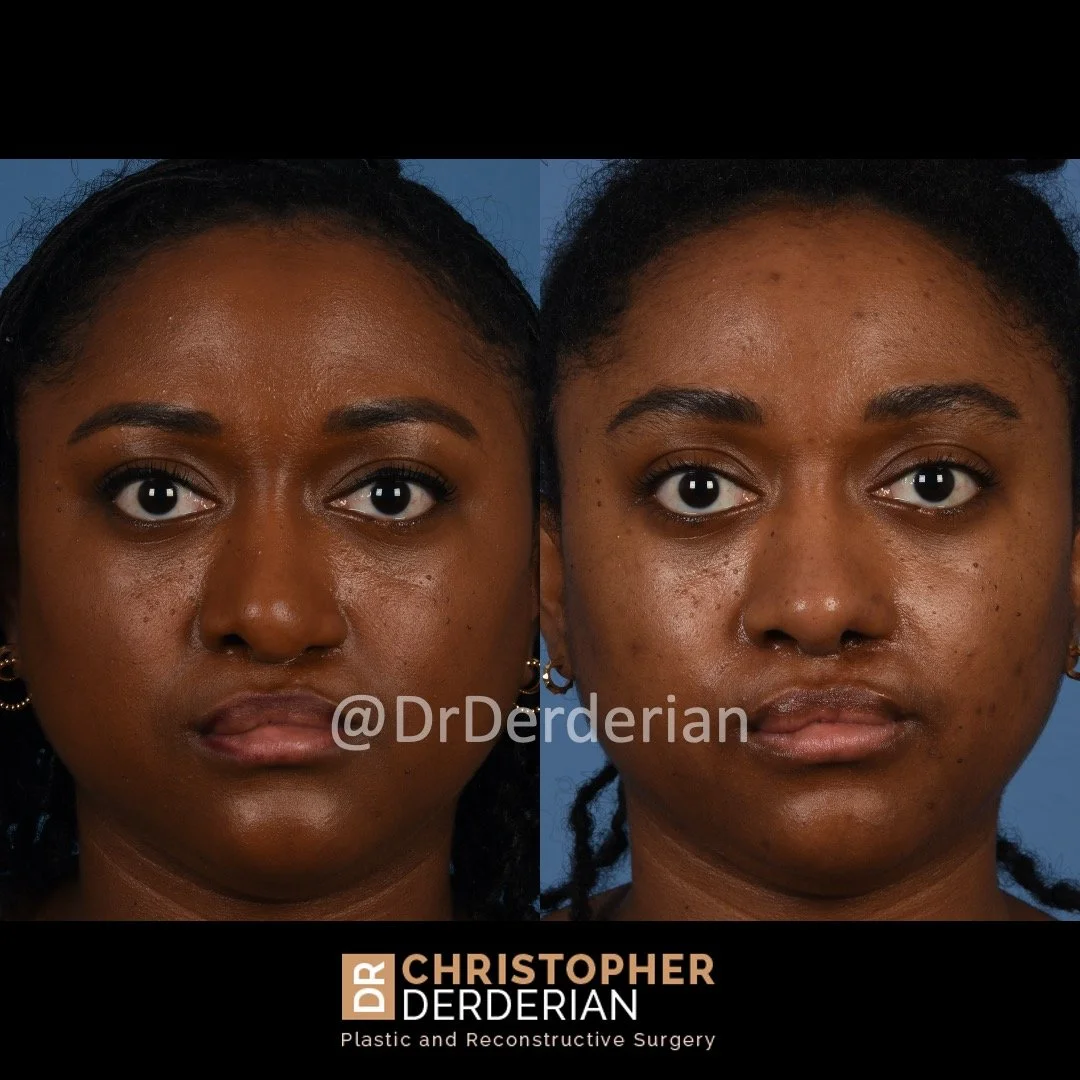 before and after cleft rhinoplasty case 8 AP