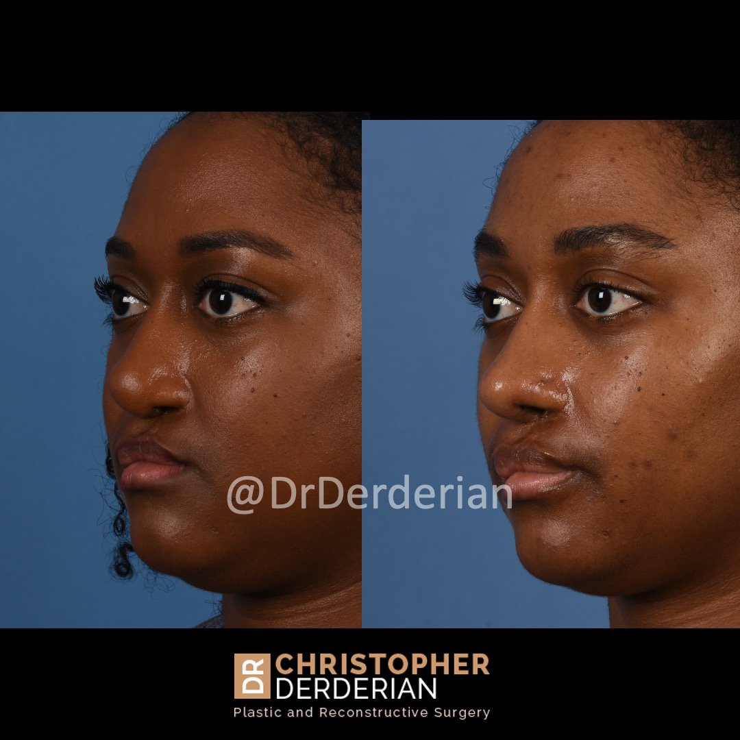 before and after cleft rhinoplasty case 8 left 3/4