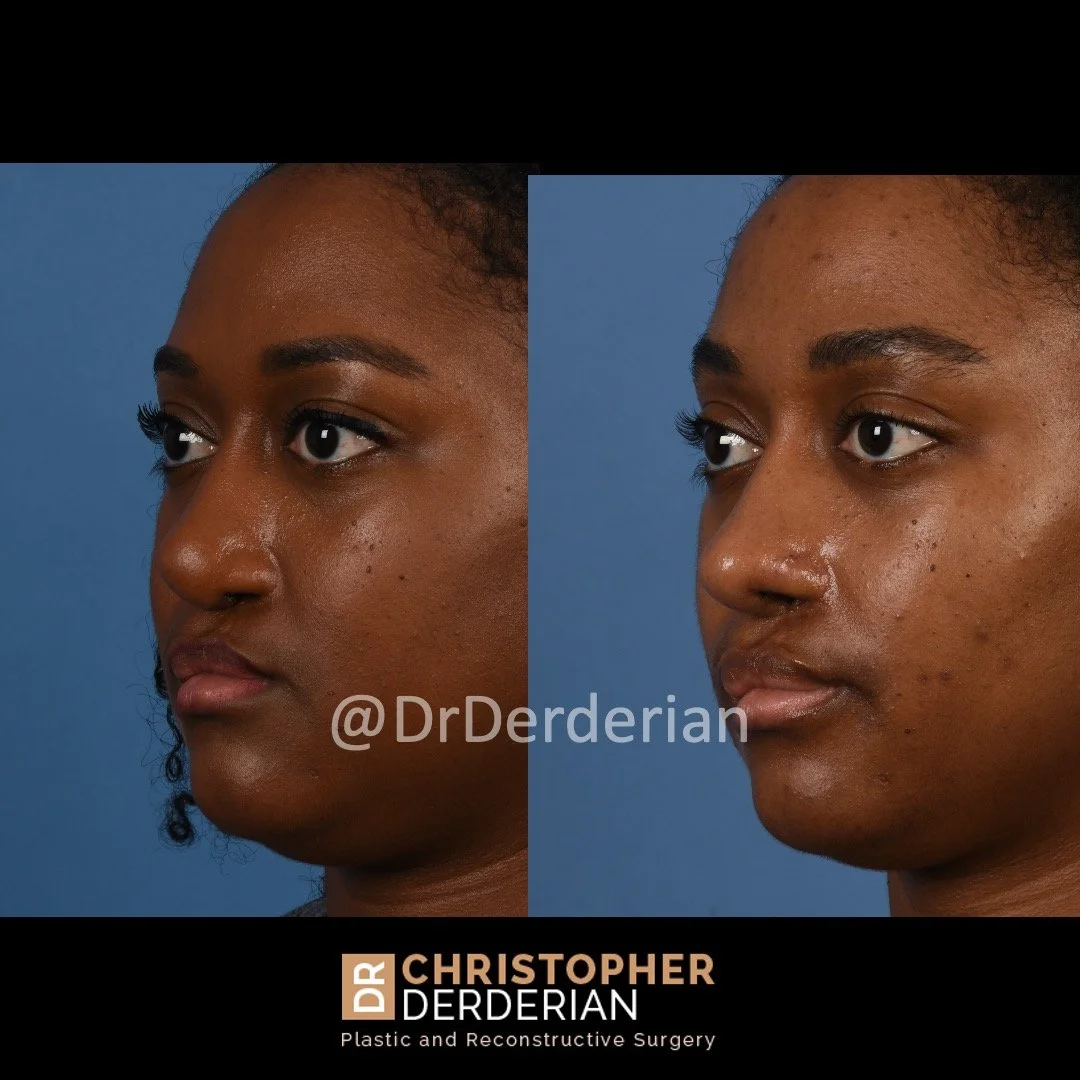 Cleft Rhinoplasty — Dr Derderian — Plastic and Reconstructive Surgery