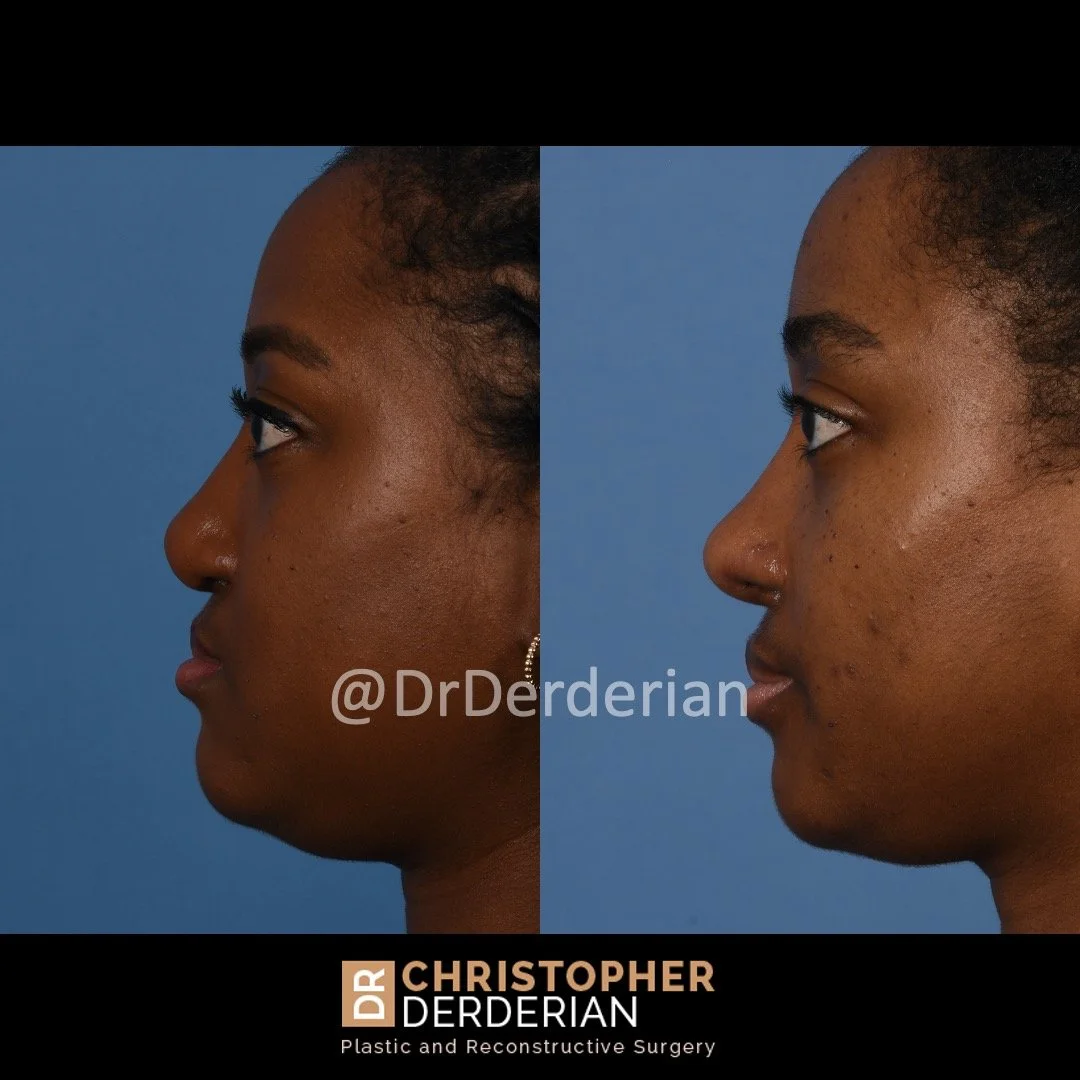 before and after cleft rhinoplasty case 8 left lateral