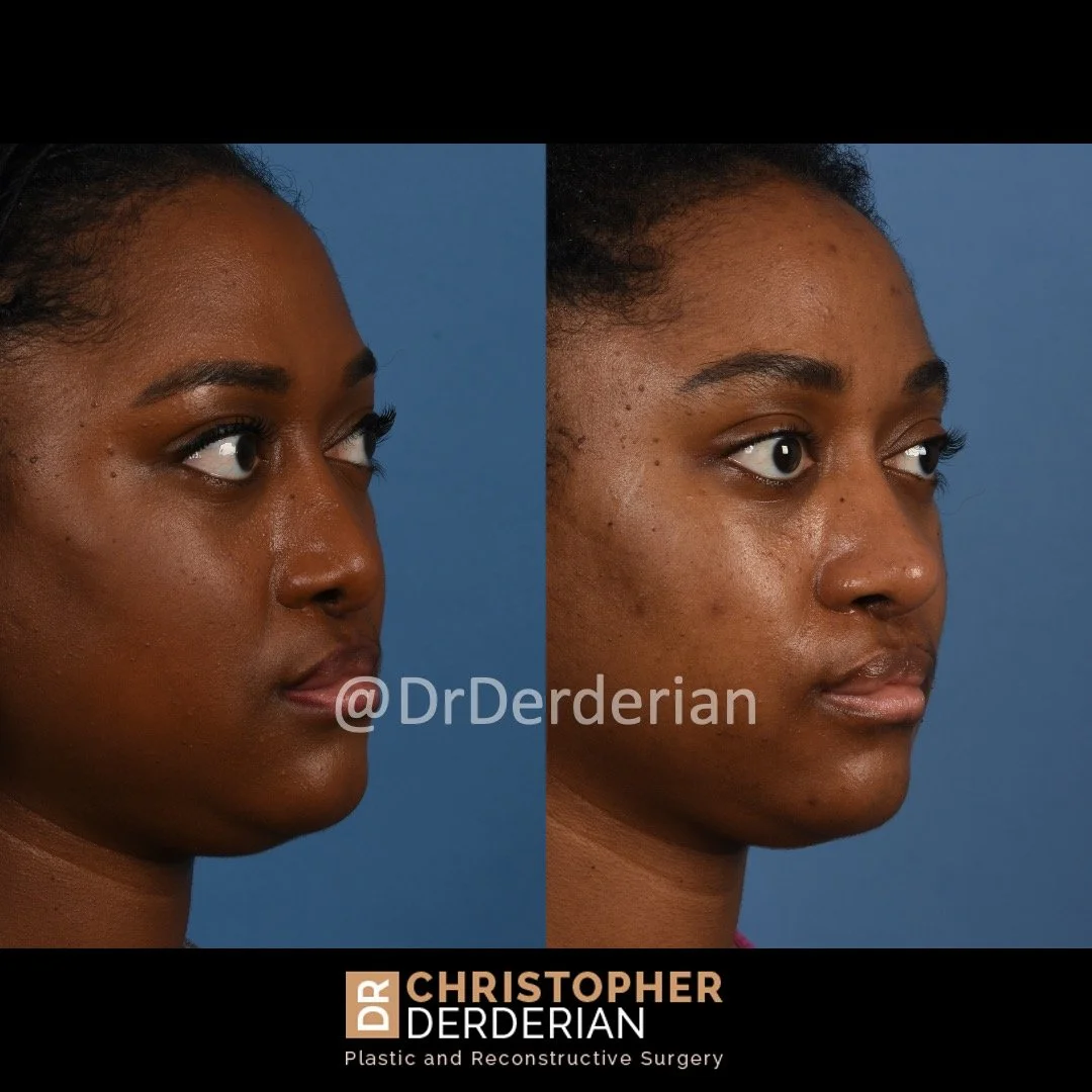 before and after cleft rhinoplasty case 8 right 3/4
