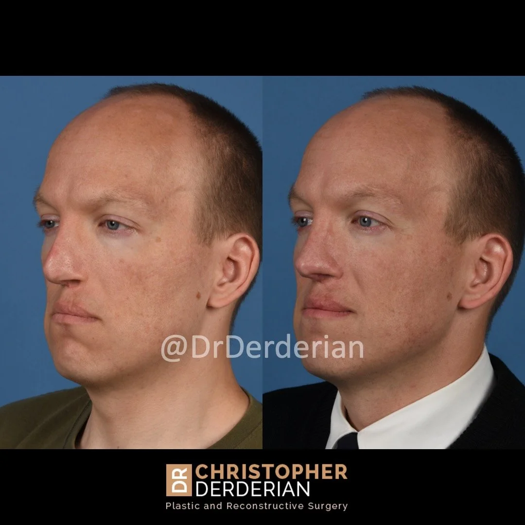 before and after cleft rhinoplasty case 9 left 3/4