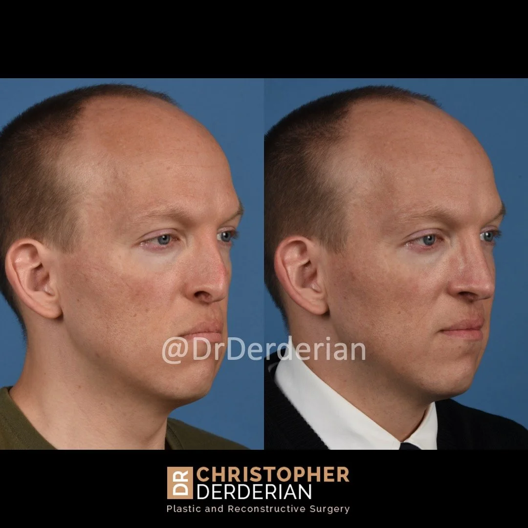 before and after cleft rhinoplasty case 9 right 3/4