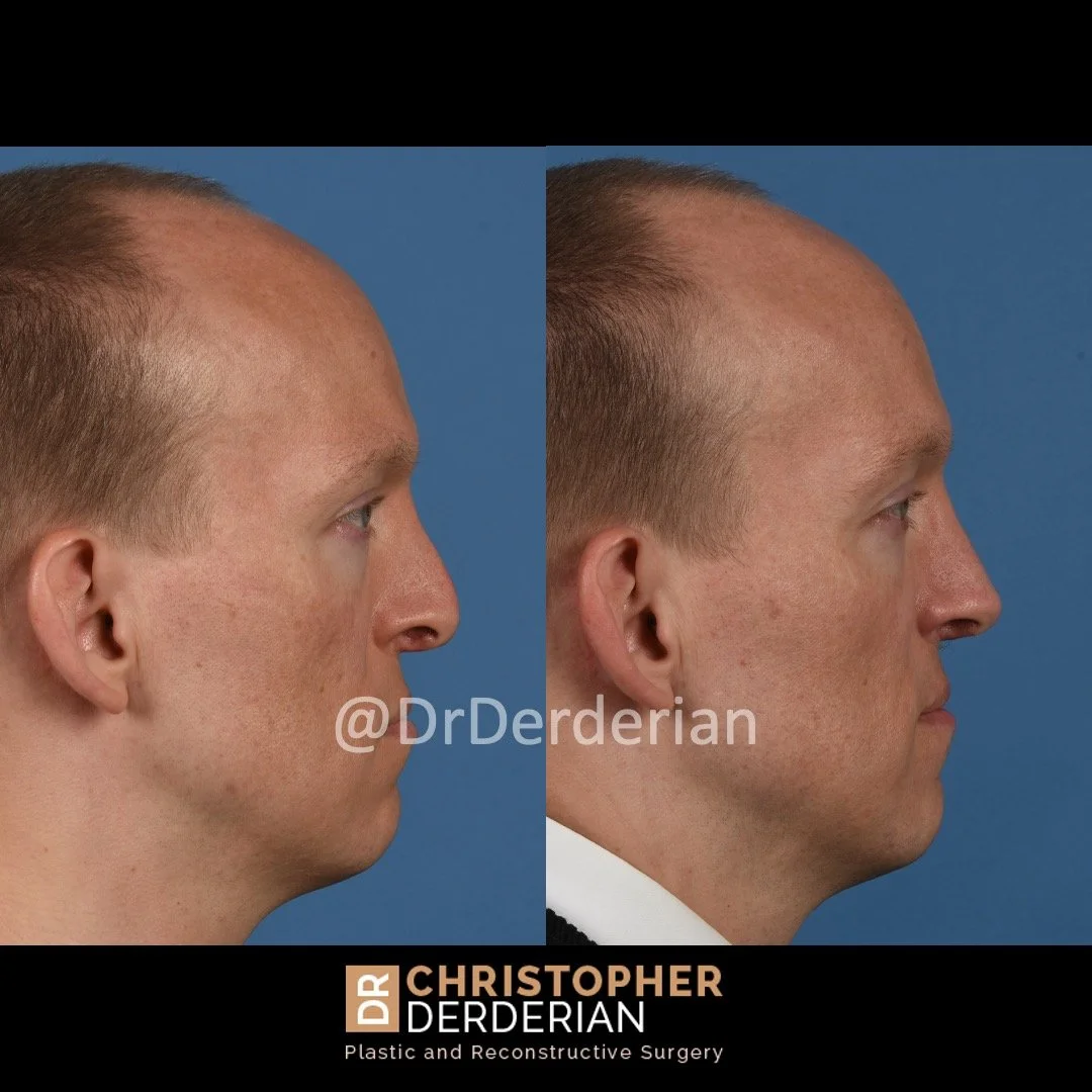 before and after cleft rhinoplasty case 9 right lateral