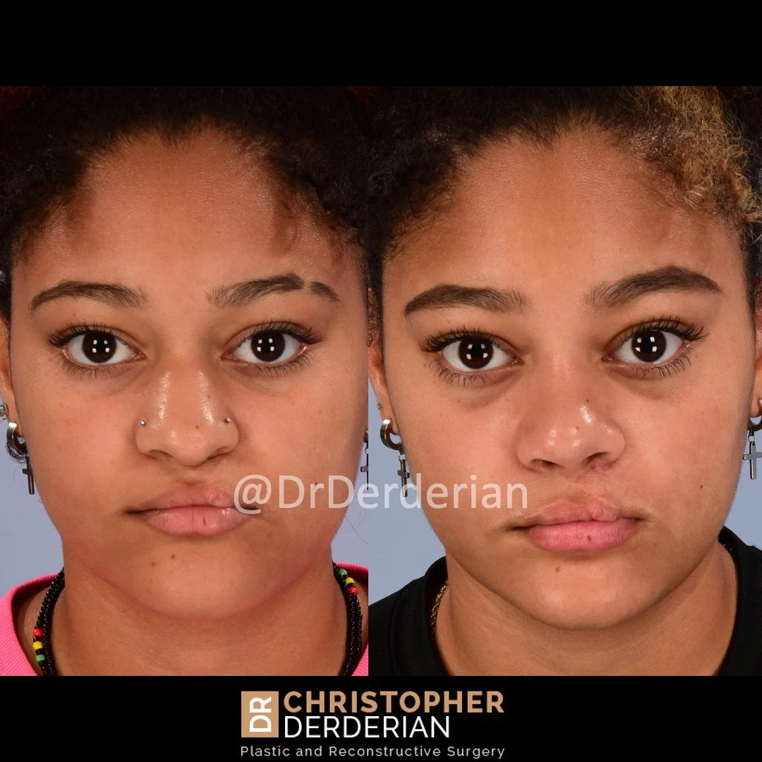 before and after cleft rhinoplasty case 10 AP