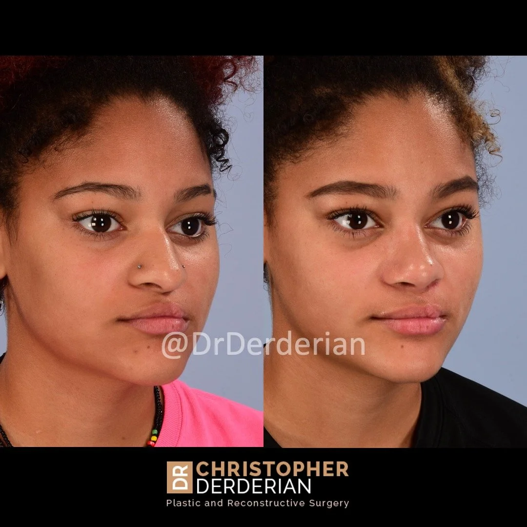 before and after cleft rhinoplasty case 10 right 3/4
