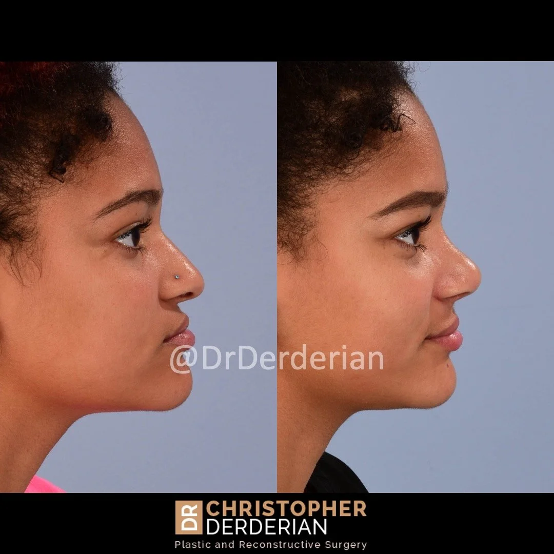 before and after cleft rhinoplasty case 10 right lateral