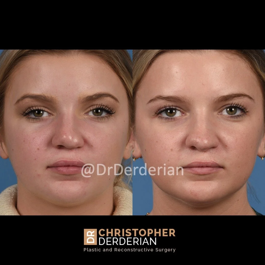 before and after cleft rhinoplasty case 11 AP