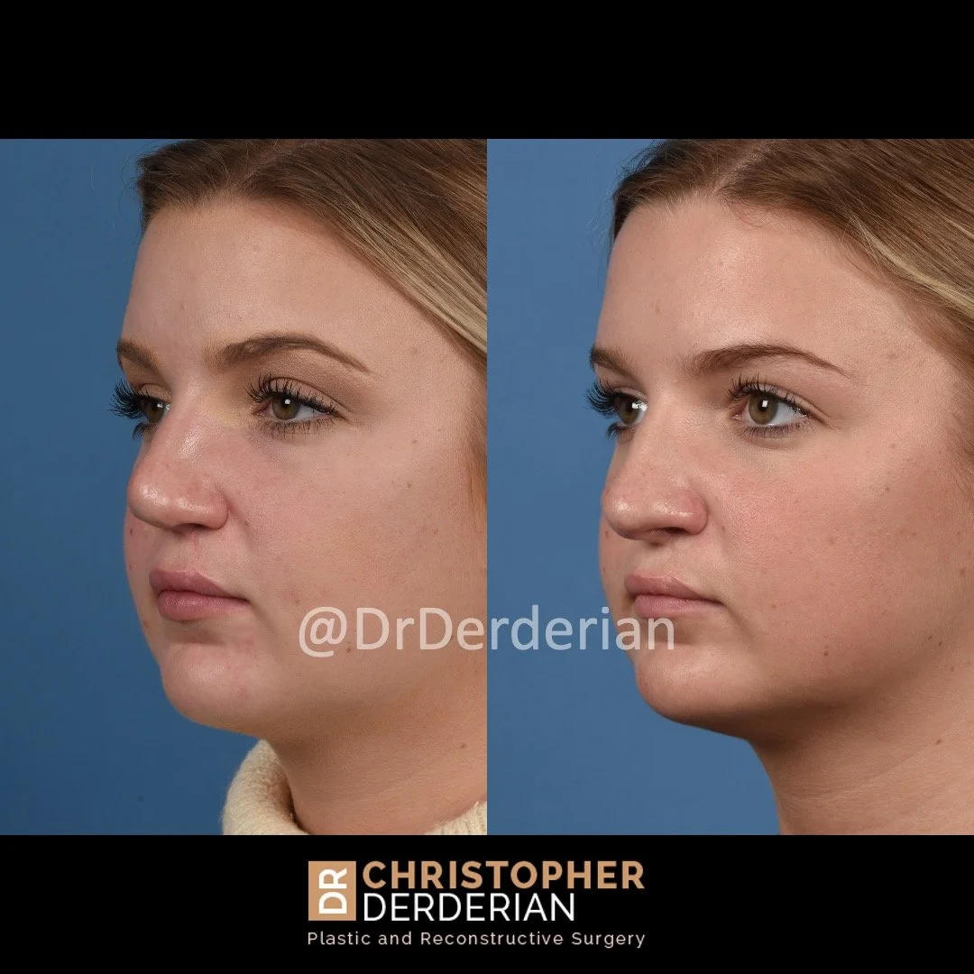 before and after cleft rhinoplasty case 11 left 3/4