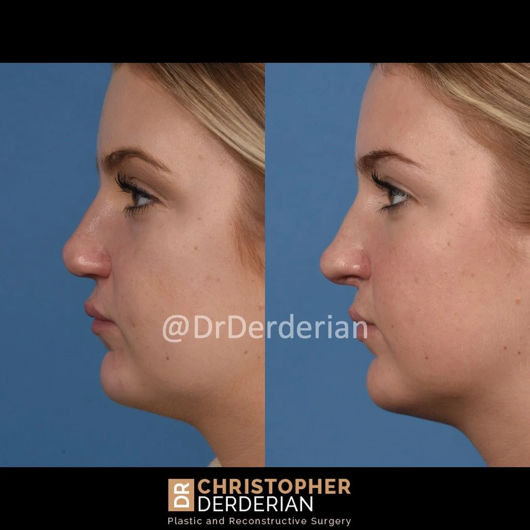 before and after cleft rhinoplasty case 11 left 3/4
