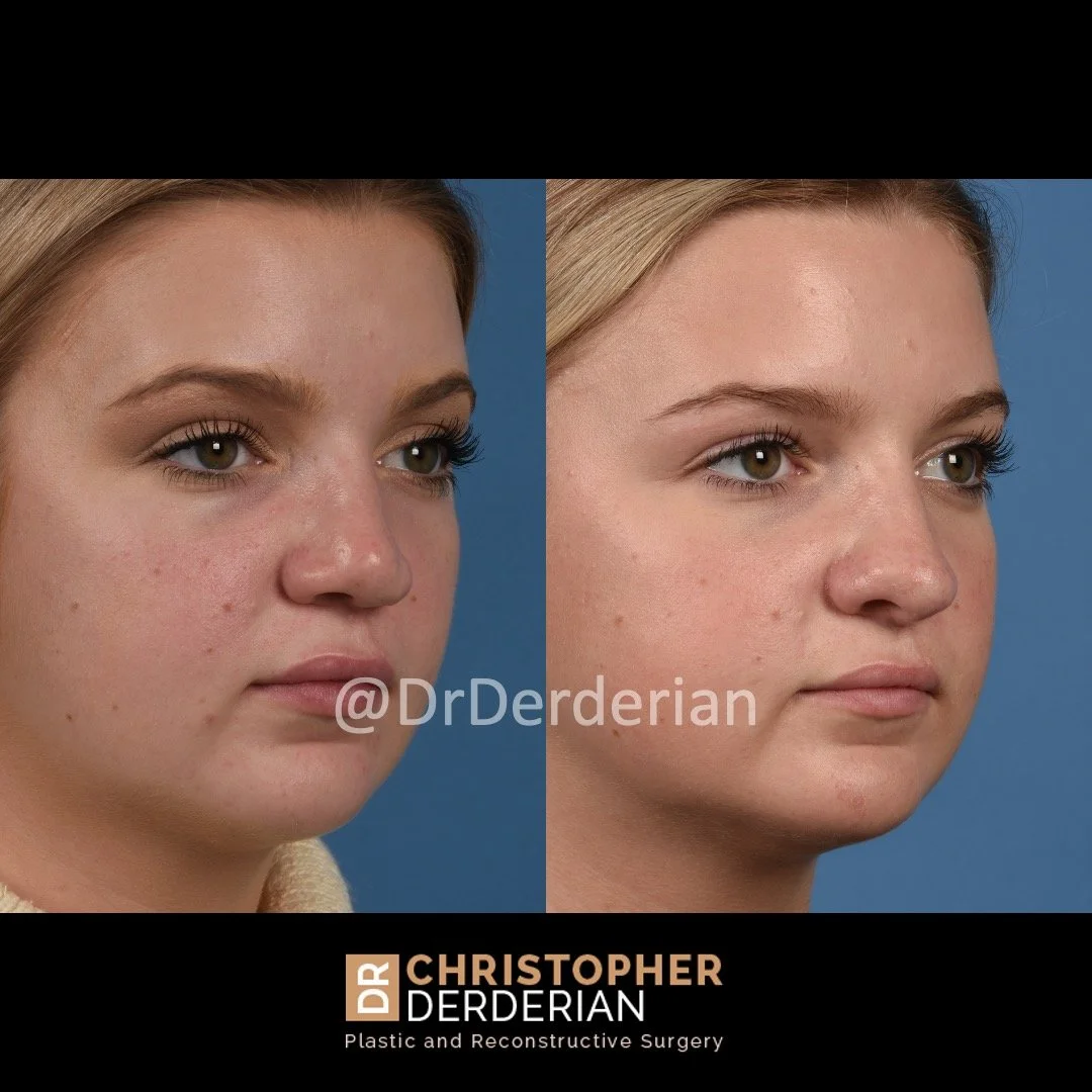 before and after cleft rhinoplasty case 11 right 1/2
