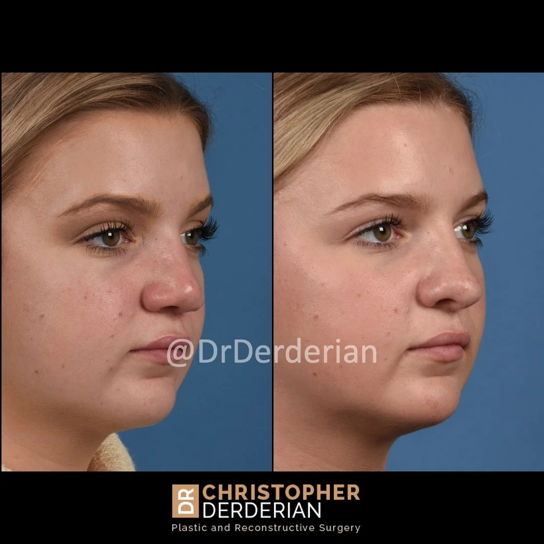 before and after cleft rhinoplasty case 11 left 3/4
