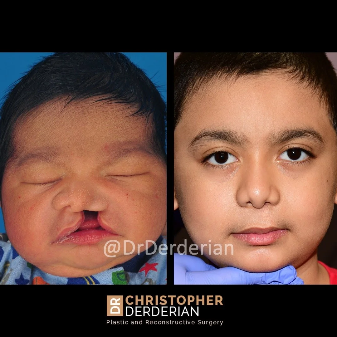 drderderian cleft lip before and after 8yo front.jpeg