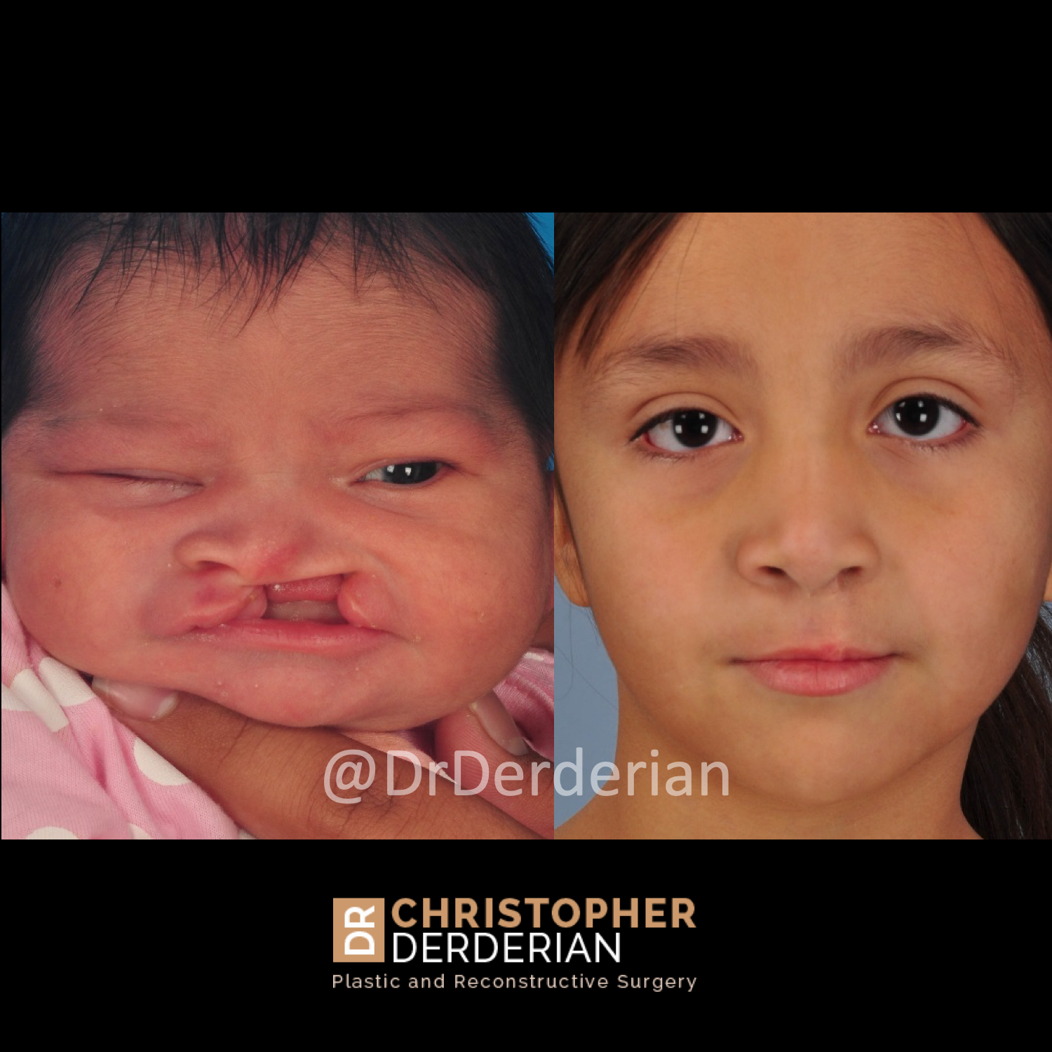 DrDerderian Cleft Lip Repair 6 year Postop.png