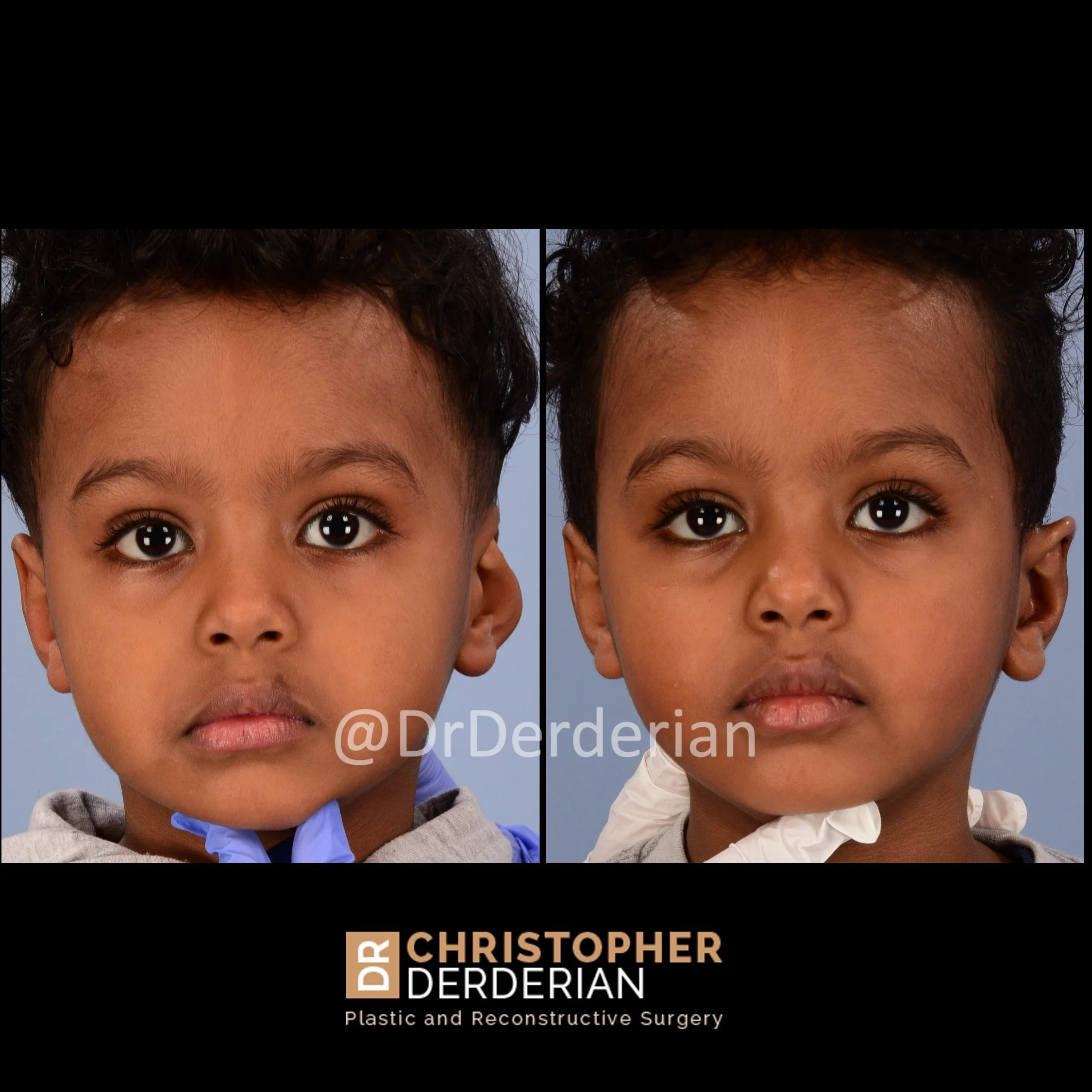 drderderian cryptotia before and after AP.jpeg