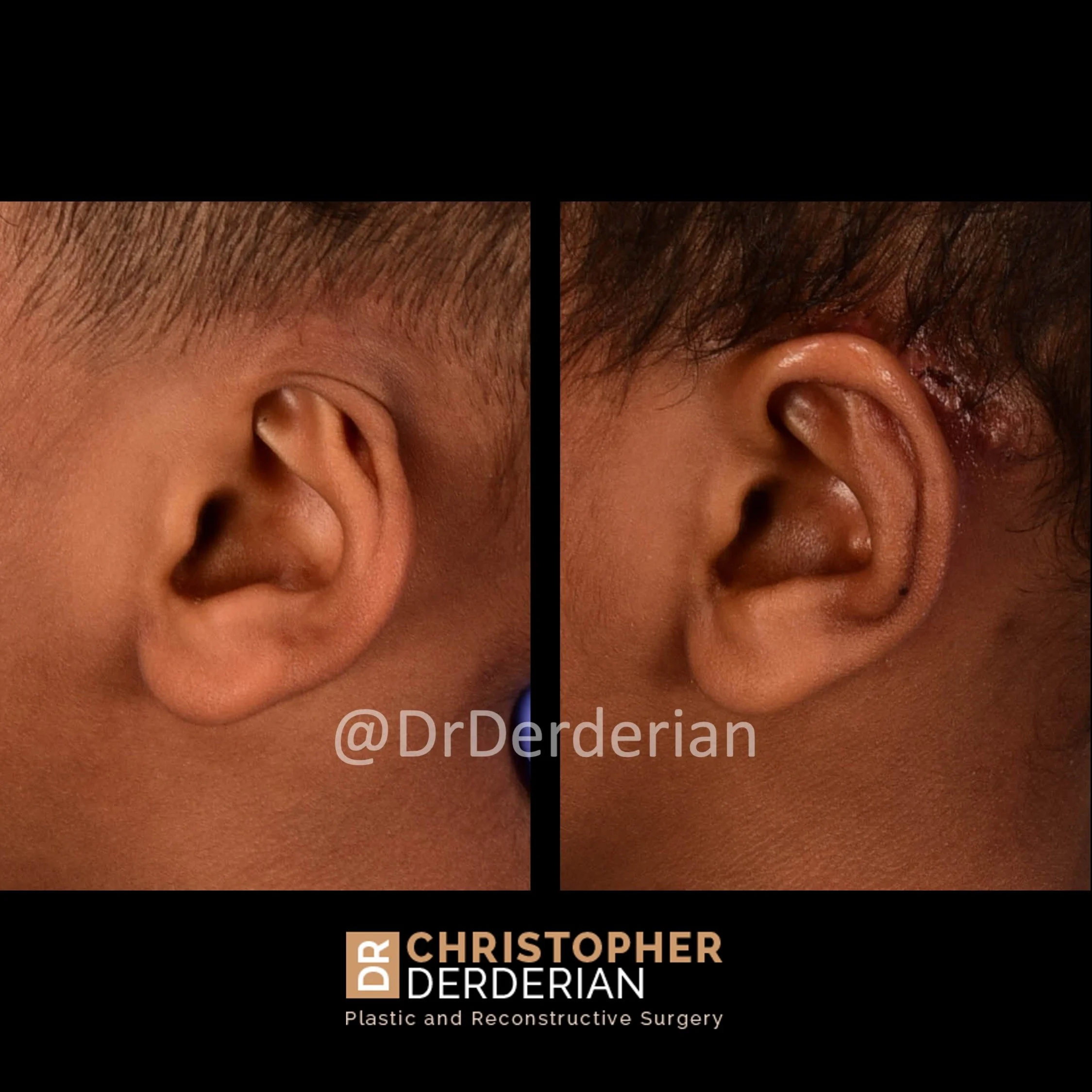 drderderian cryptotia before and after lateral .jpeg