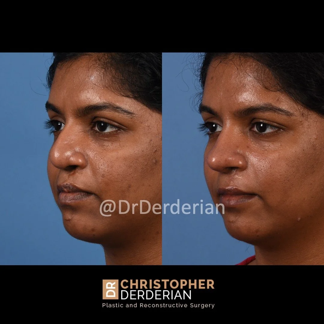 Adult Cleft Rhinoplasty & Cleft Lip Revision — Dr Derderian — Plastic ...