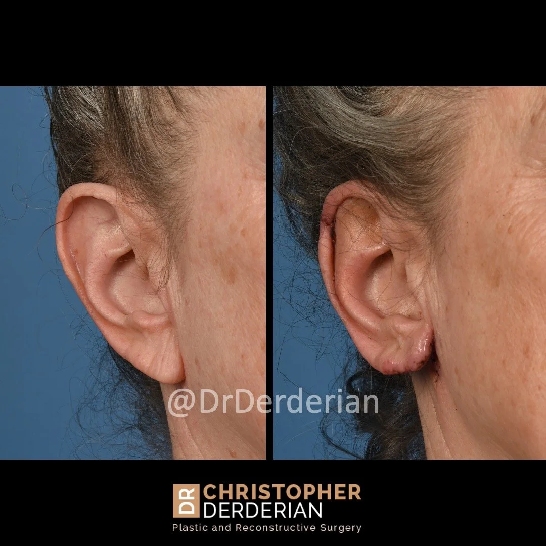 before and after ear reduction procedure, reduction otoplasty ear lobe reduction 3/4 view