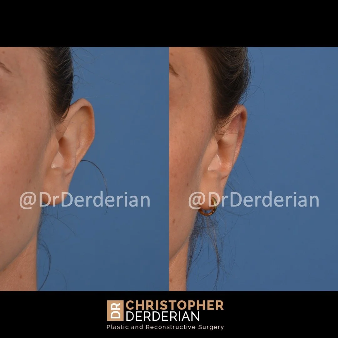 before and after ear reduction procedure, reduction otoplasty front view