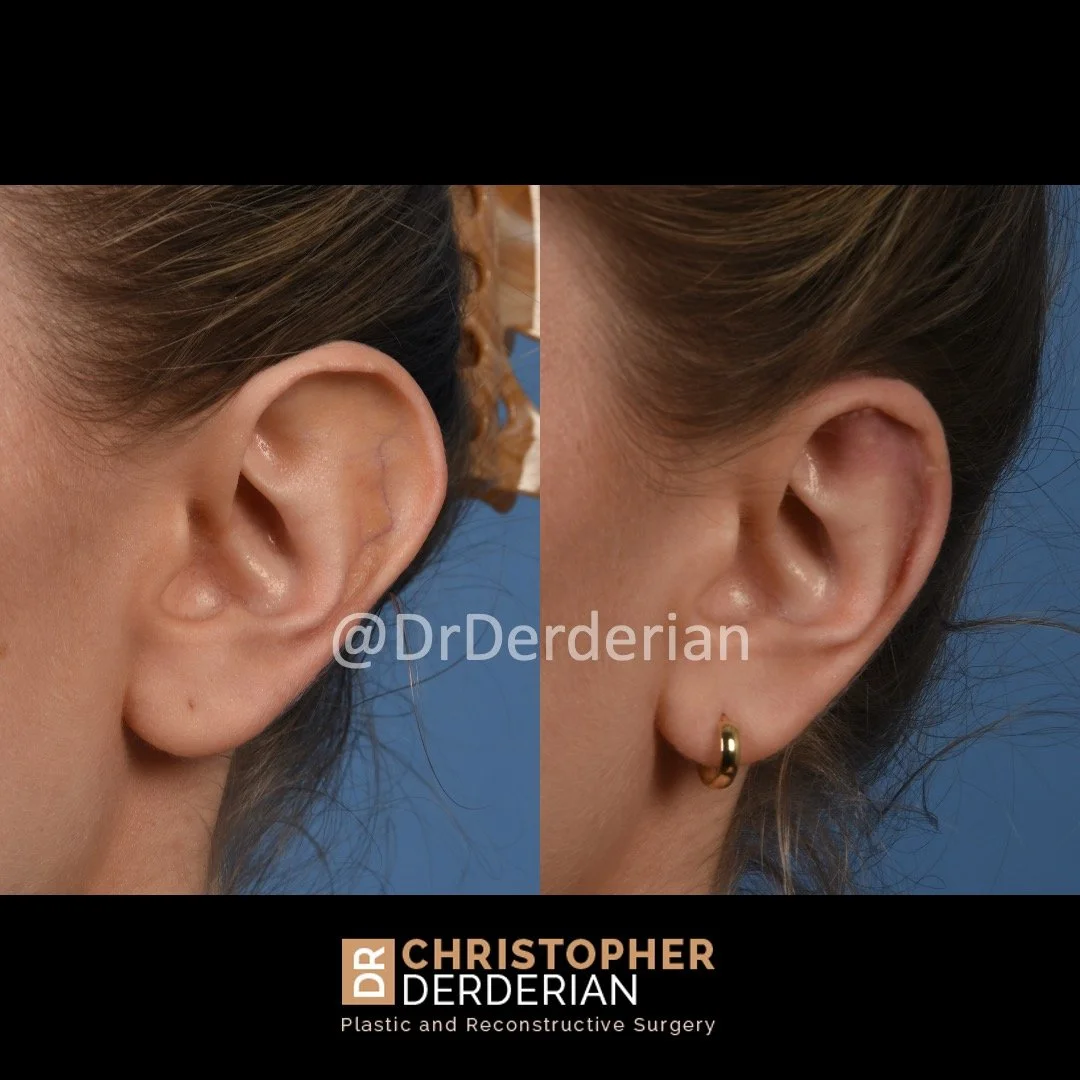 before and after ear reduction procedure, reduction otoplasty left 3/4 view