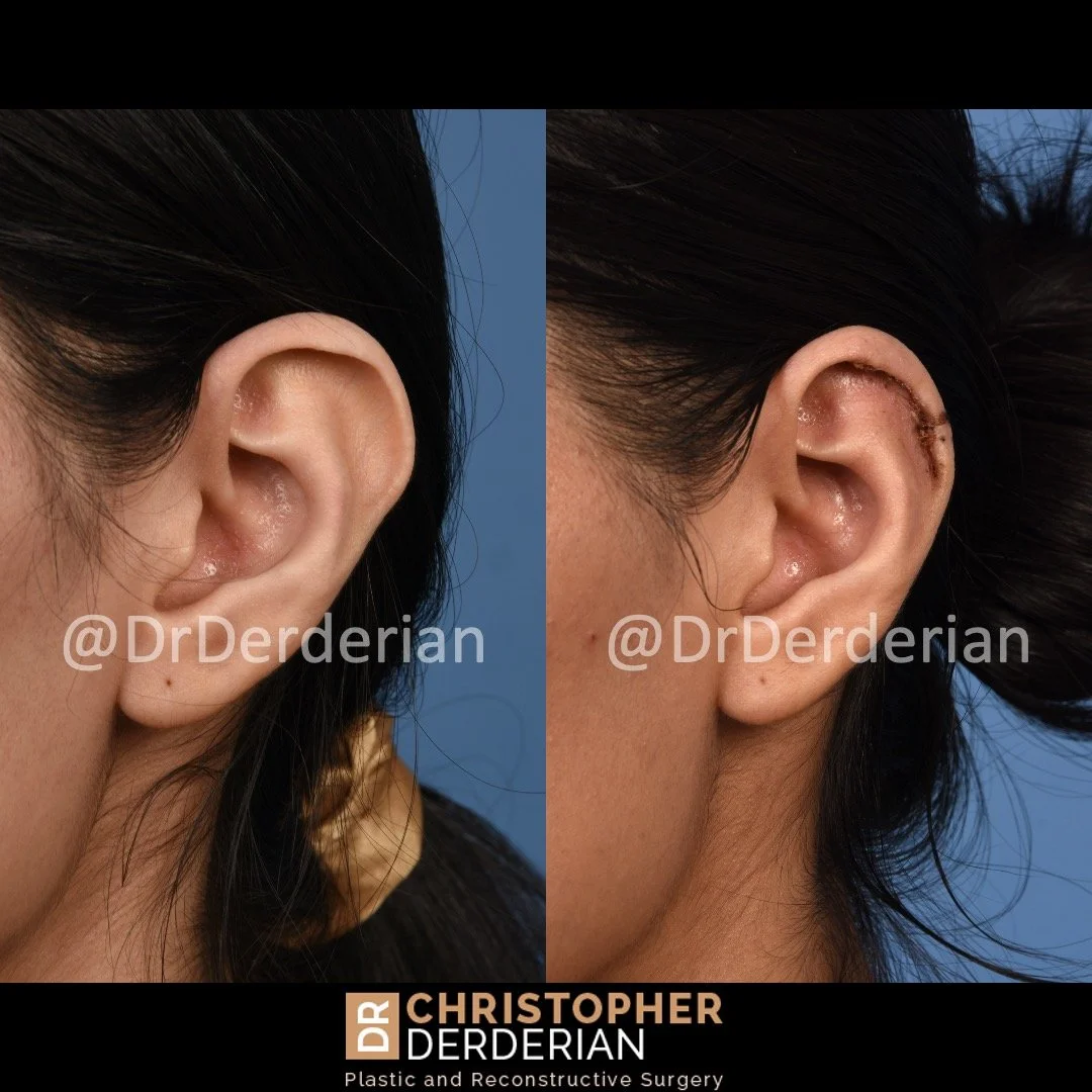 before and after ear reduction procedure, reduction otoplasty left 3/4