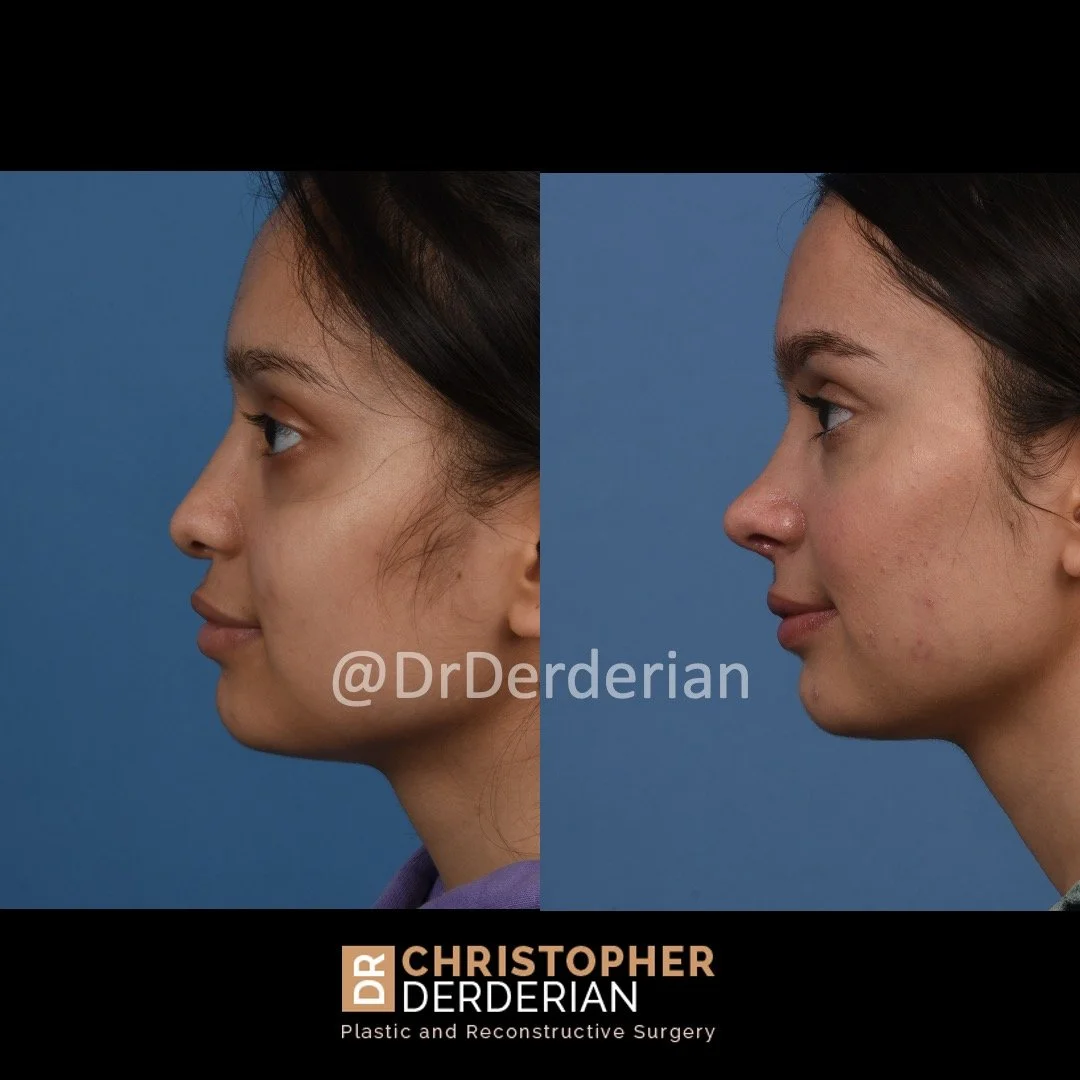 before and after cleft rhinoplasty and cleft lip revision case 3 left lateral