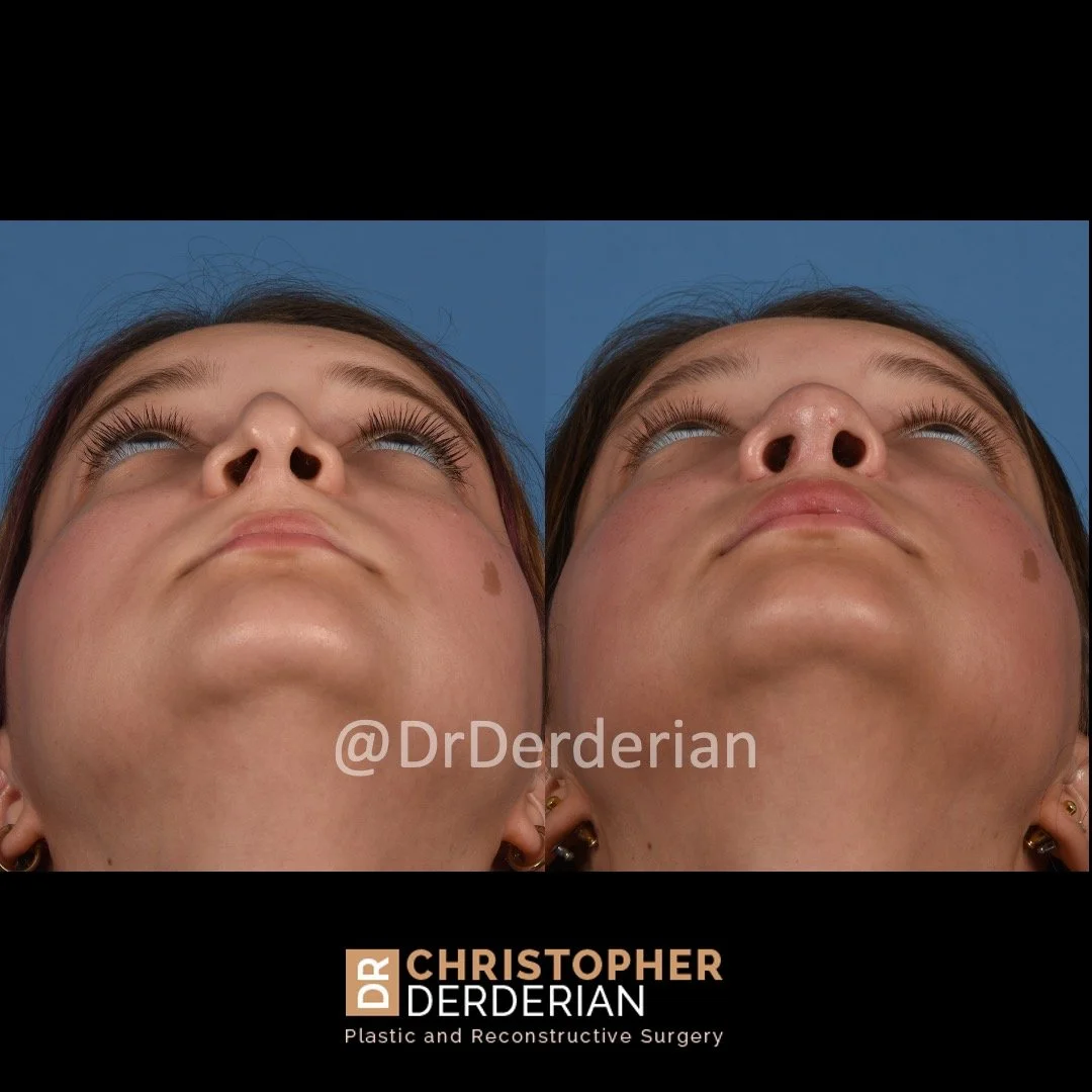 before and after cleft rhinoplasty case 12 below