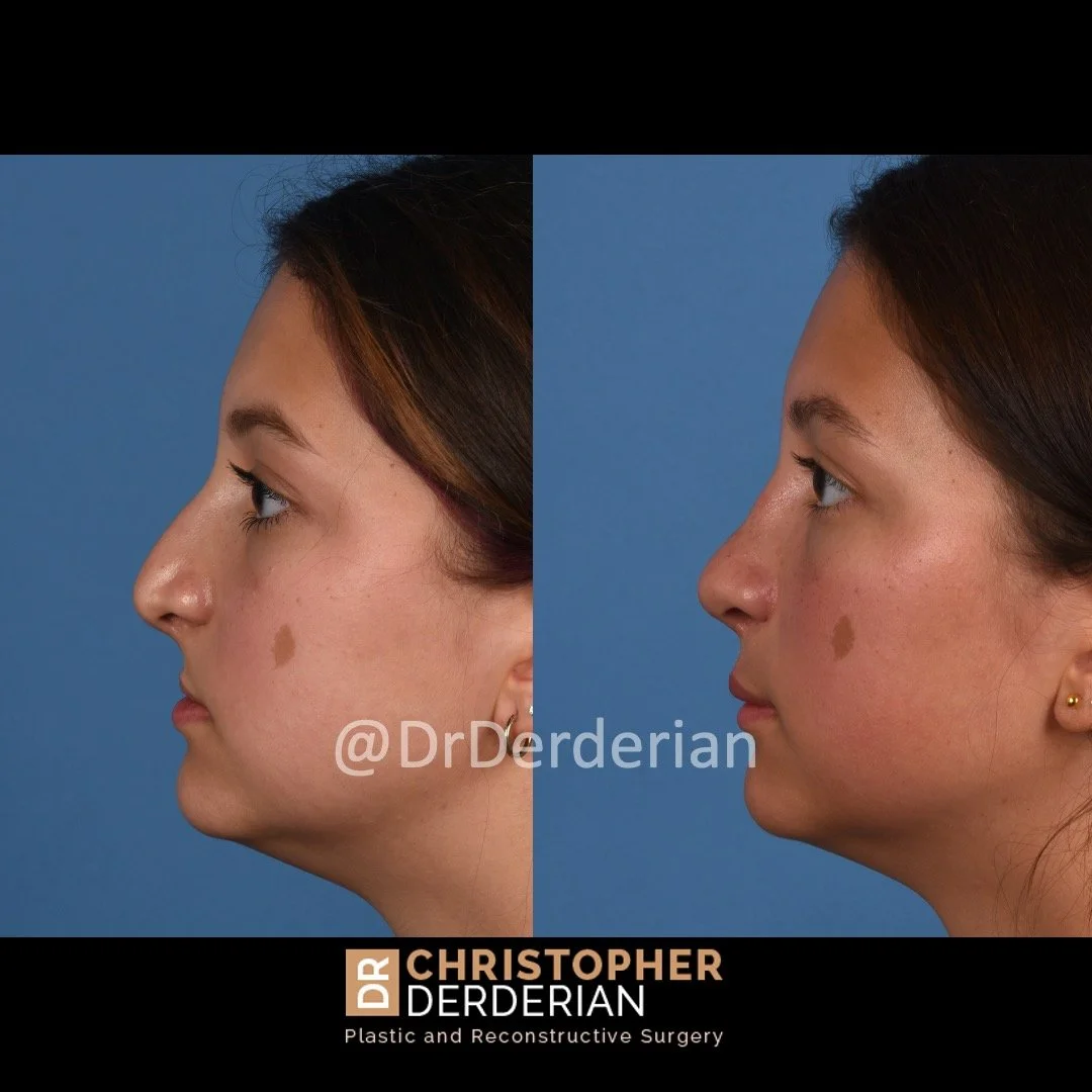 before and after cleft rhinoplasty case 12 left lateral