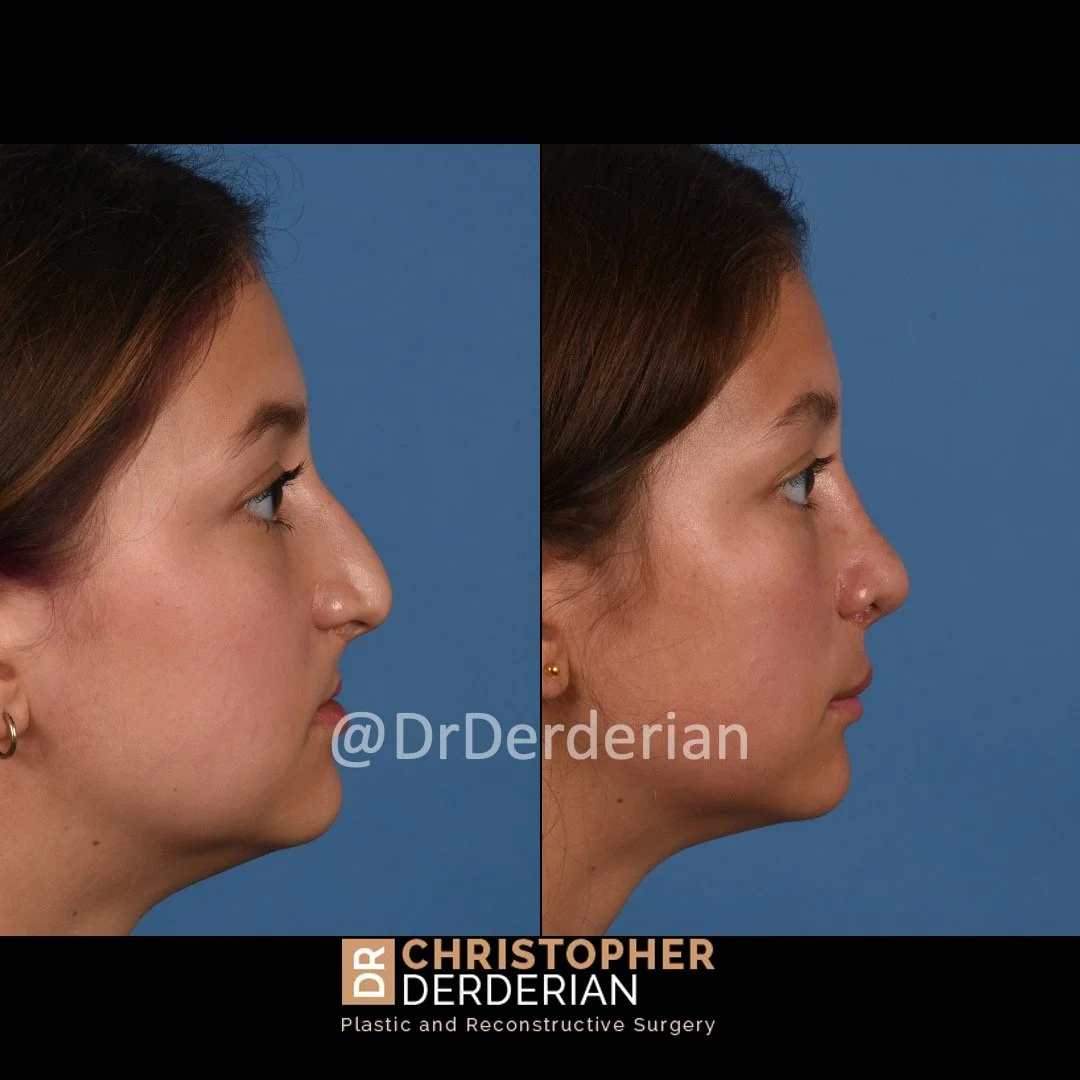 before and after cleft rhinoplasty case 12 right lateral