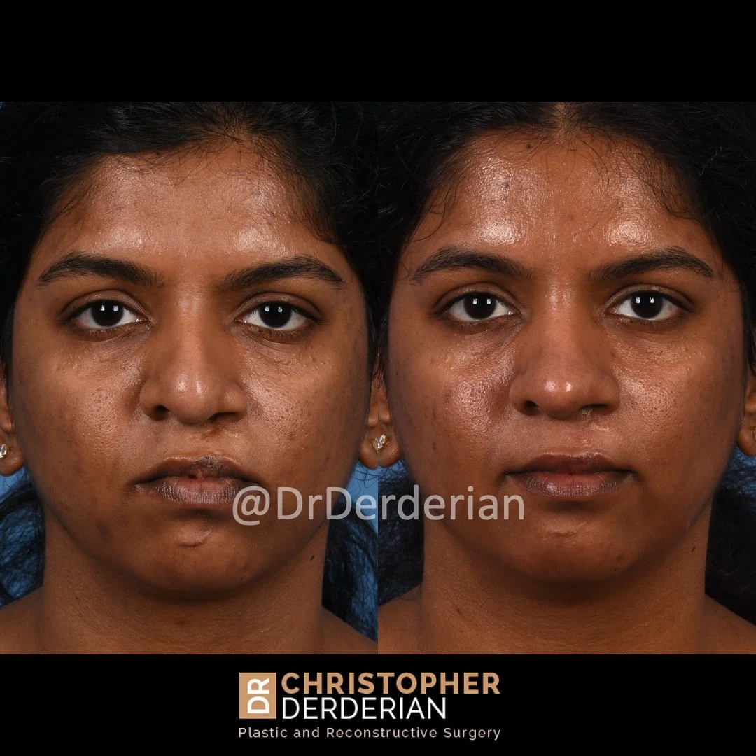 before and after cleft rhinoplasty and cleft lip revision case 13 AP