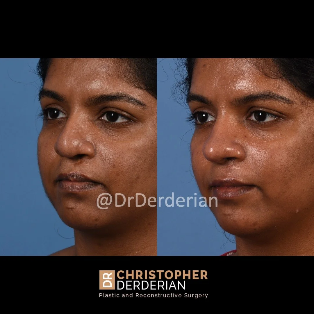 before and after cleft rhinoplasty and cleft lip revision case 13 left 3/4