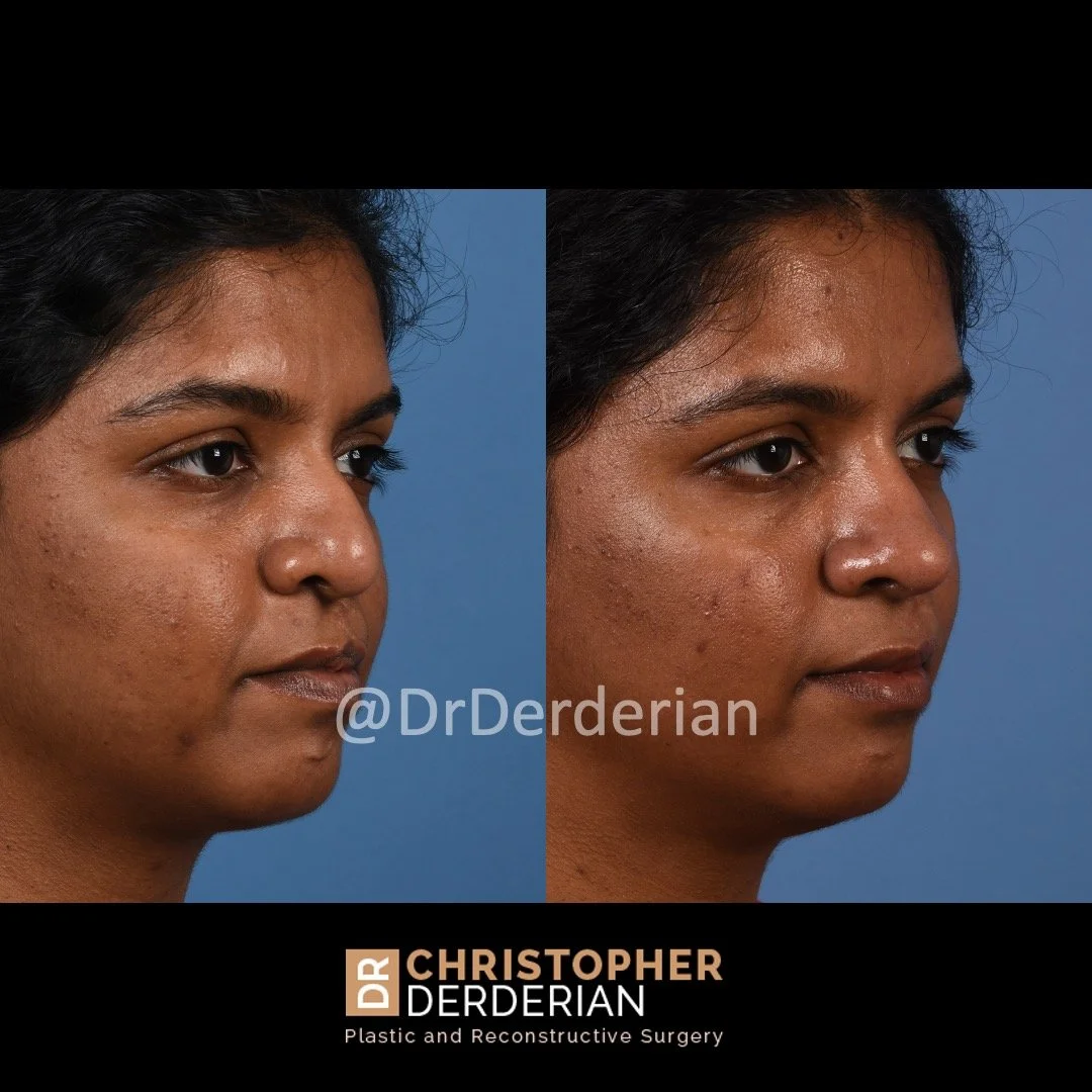 before and after cleft rhinoplasty and cleft lip revision case 13 right 3/4