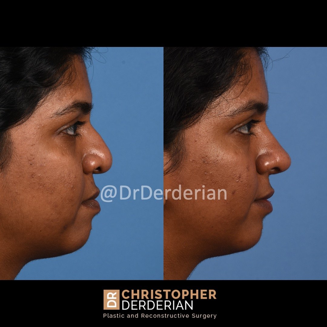 before and after cleft rhinoplasty and cleft lip revision case 13 right lateral